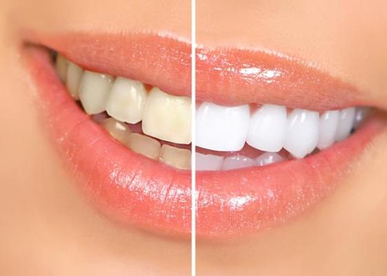 3 Simple Practices to Extend Your Teeth Whitening Results