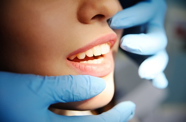 4 Benefits of Tooth-Colored Restorations