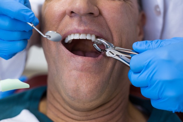 All You Need to Know About Tooth Extractions from Your Port Orange Dentist